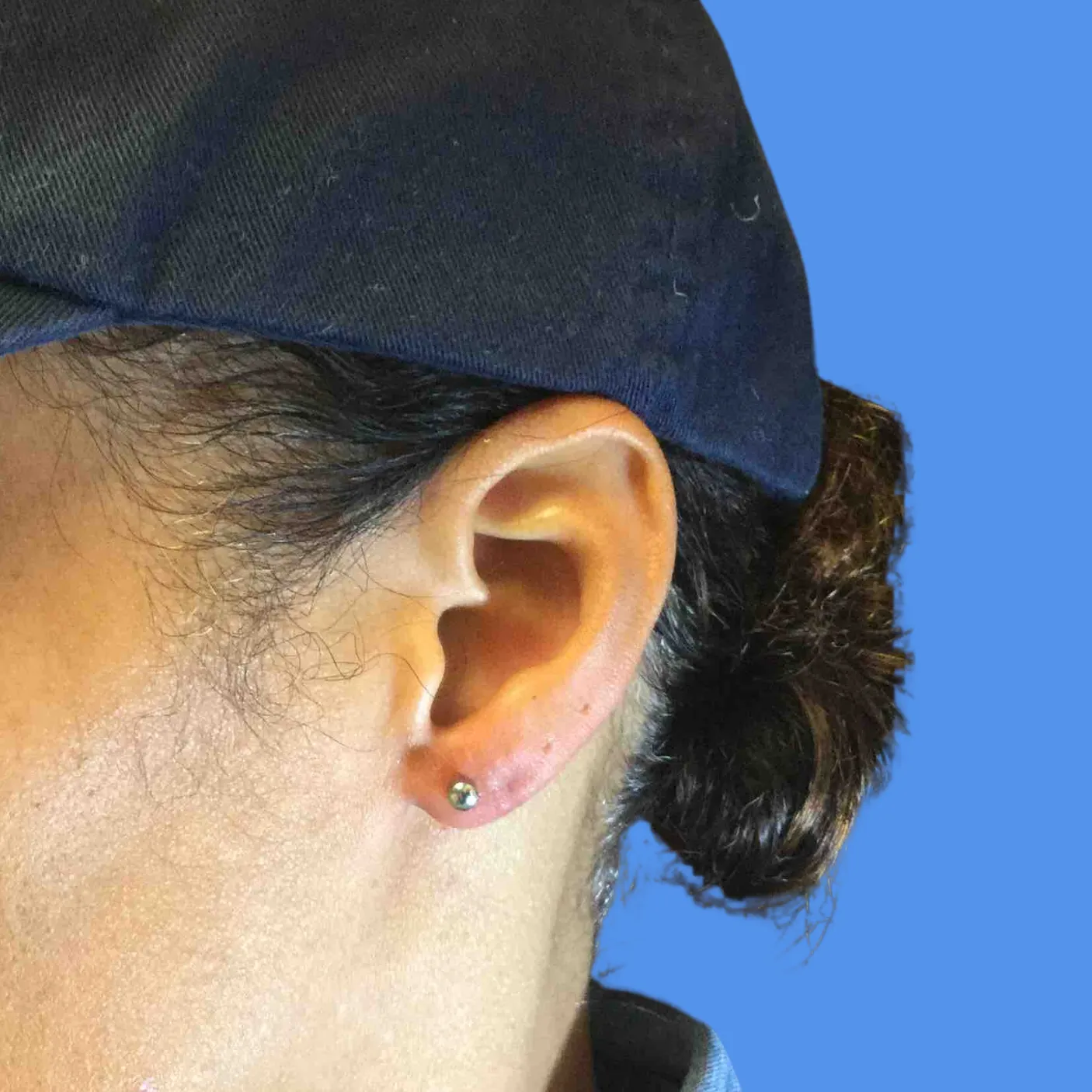 After - Earlobe Repair Patient 15