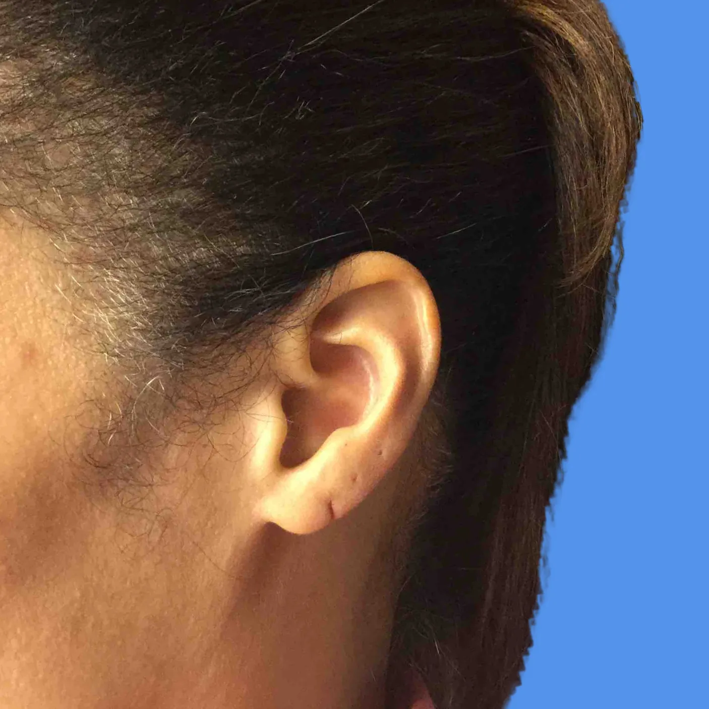 Before - Earlobe Repair Patient 15