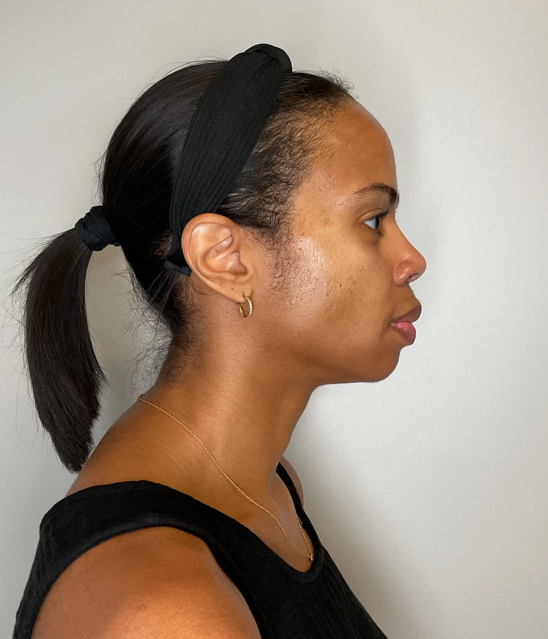 After - Facial Balancing / Fillers Patient 128