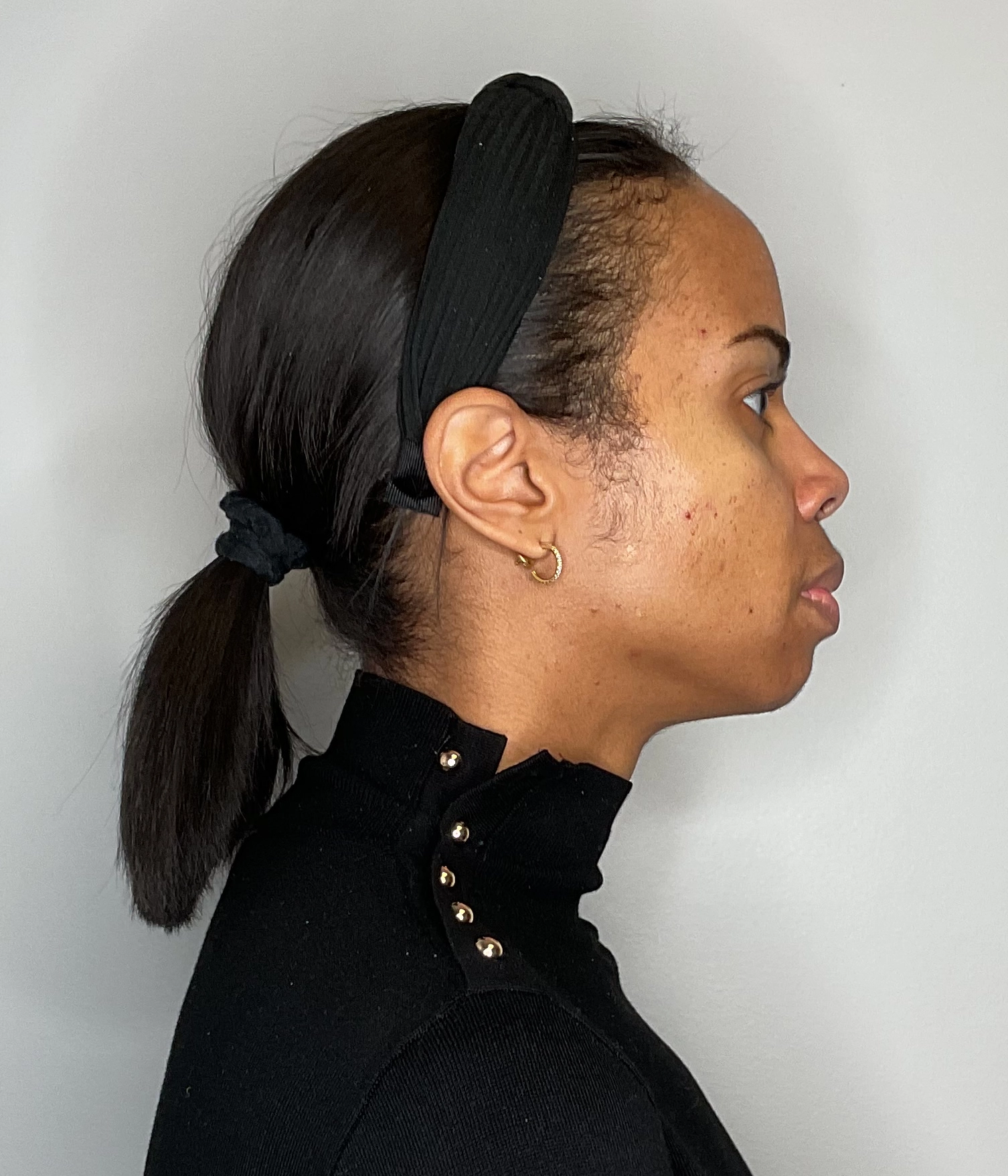 Before - Facial Balancing / Fillers Patient 128