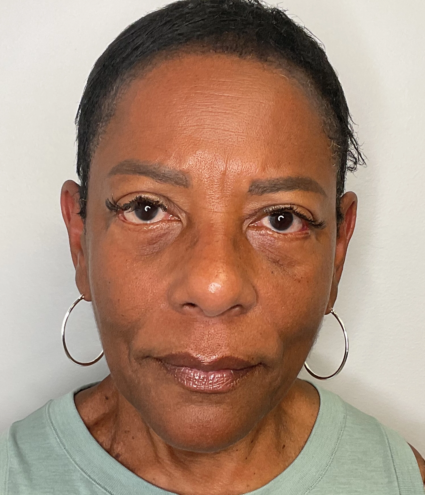 After - Facial Balancing / Filler Treatment Patient 136