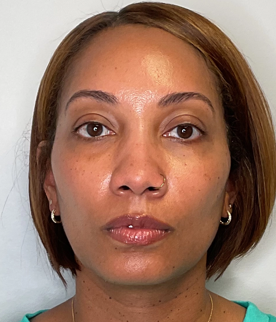 After - Facial Balancing / Filler Treatment Patient 137