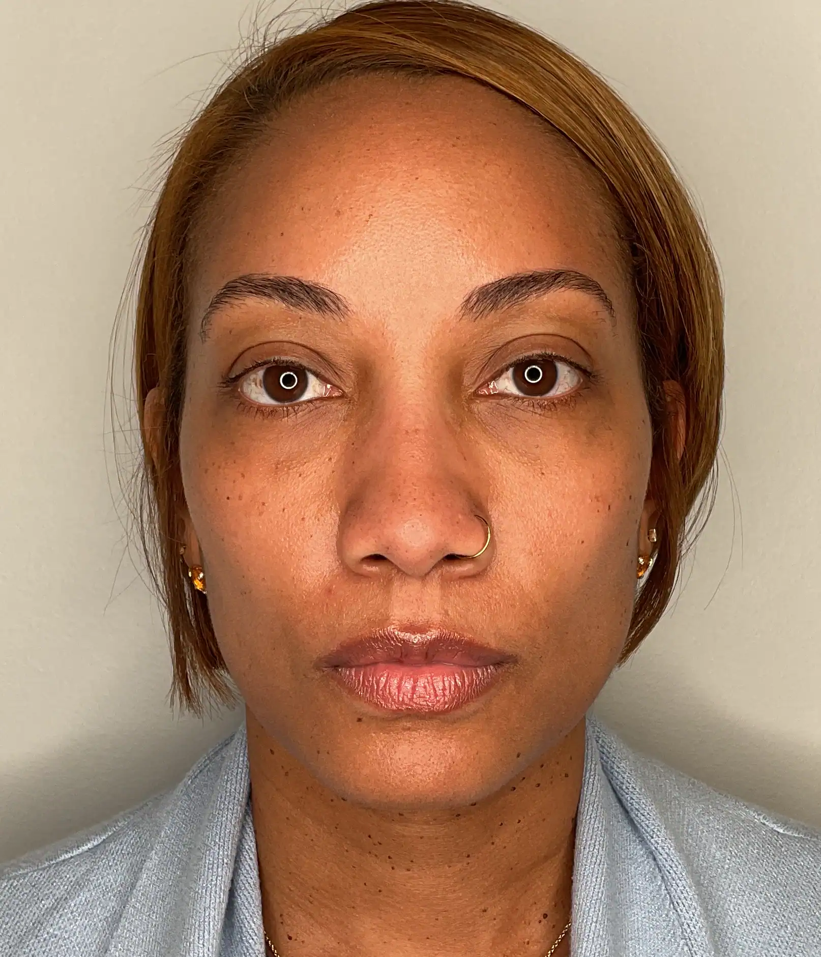 Before - Facial Balancing / Filler Treatment Patient 137