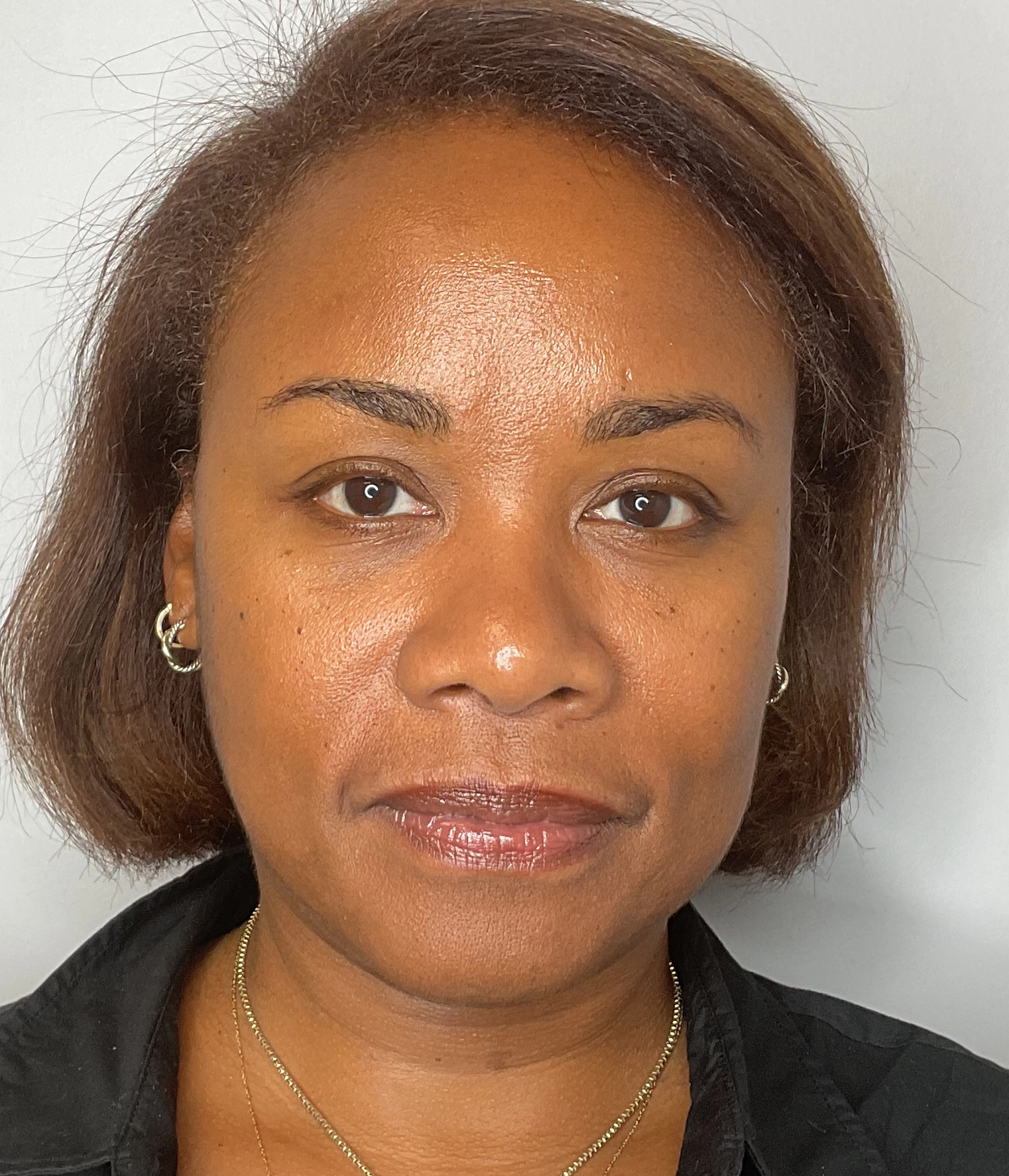 After - Facial Balancing / Filler Treatment Patient 138