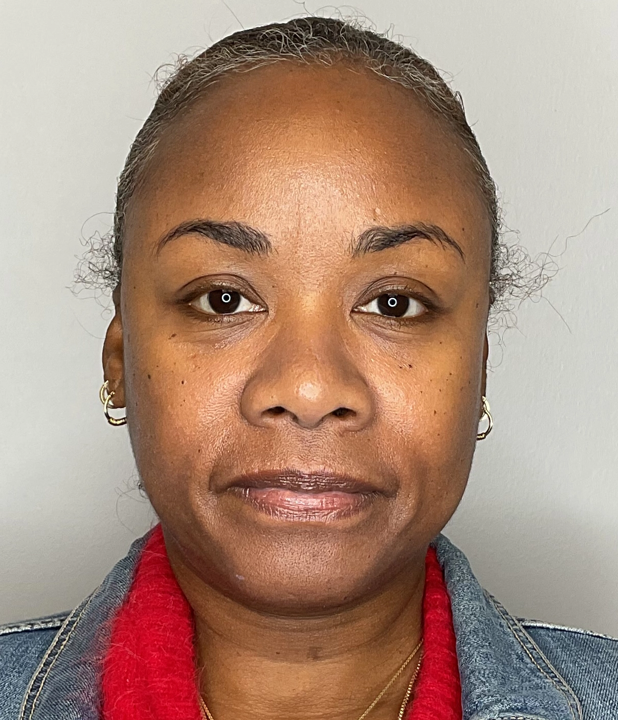 Before - Facial Balancing / Filler Treatment Patient 138
