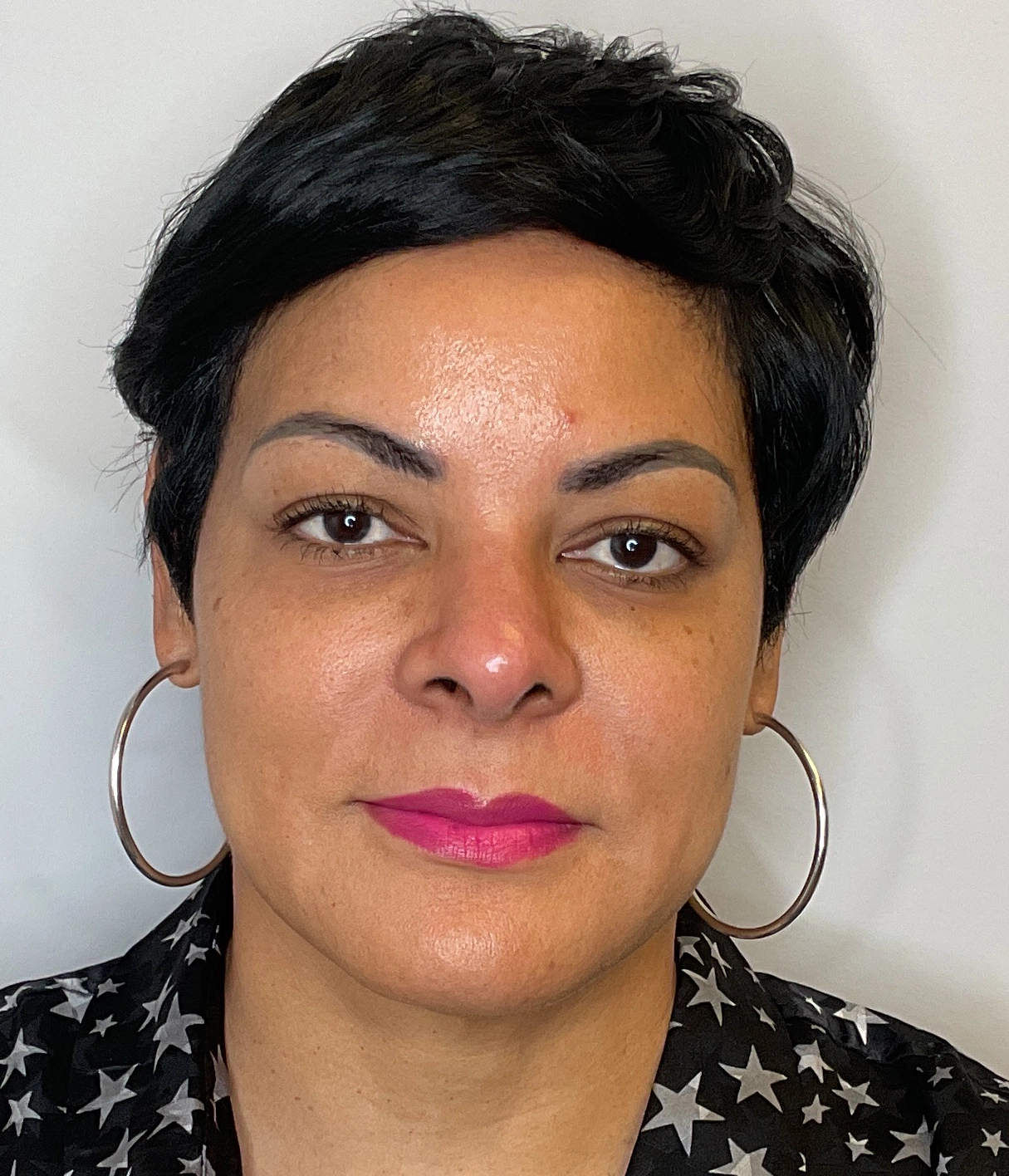 Before - Facial Balancing / Filler Treatment Patient 139
