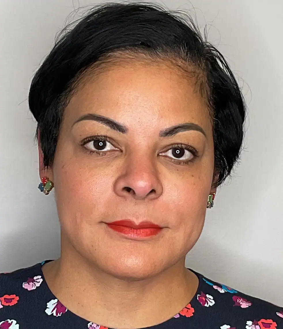 After - Facial Balancing / Filler Treatment Patient 139