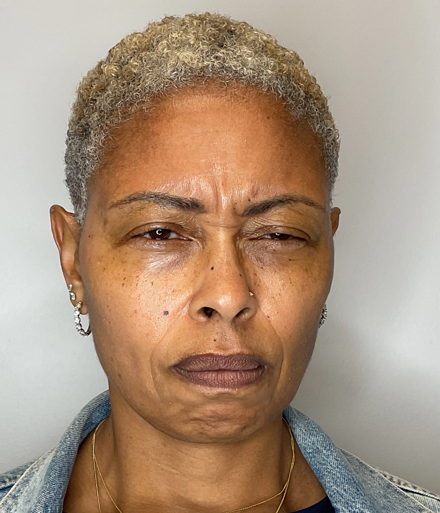 Before - Facial Balancing / Filler Treatment Patient 140