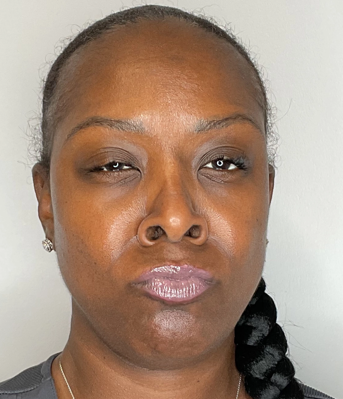 After - Facial Balancing / Filler Treatment Patient 141