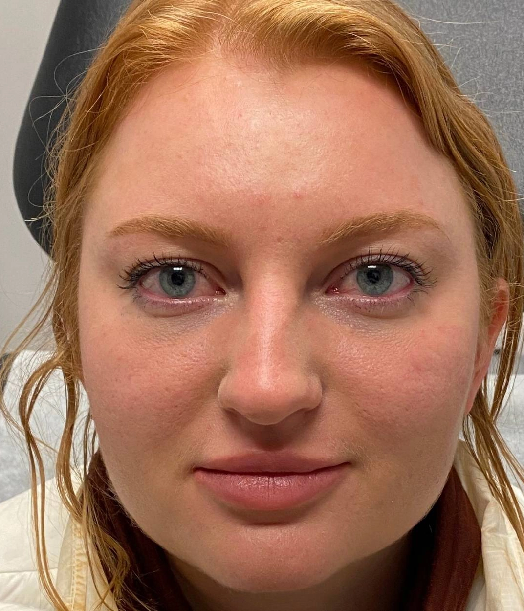 After - Facial Balancing / Filler Patient 79