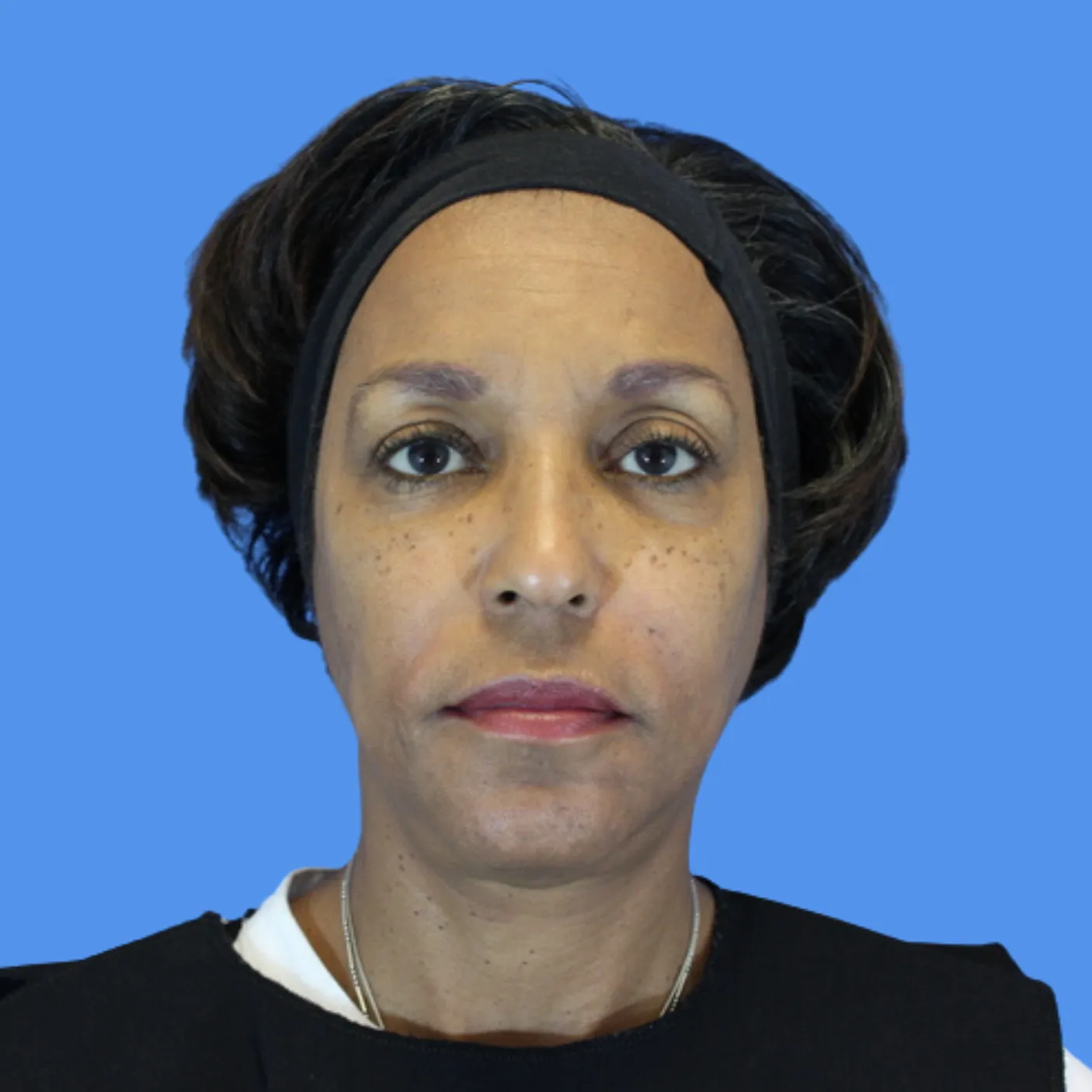 After - Facial Balancing / Fillers Patient 21