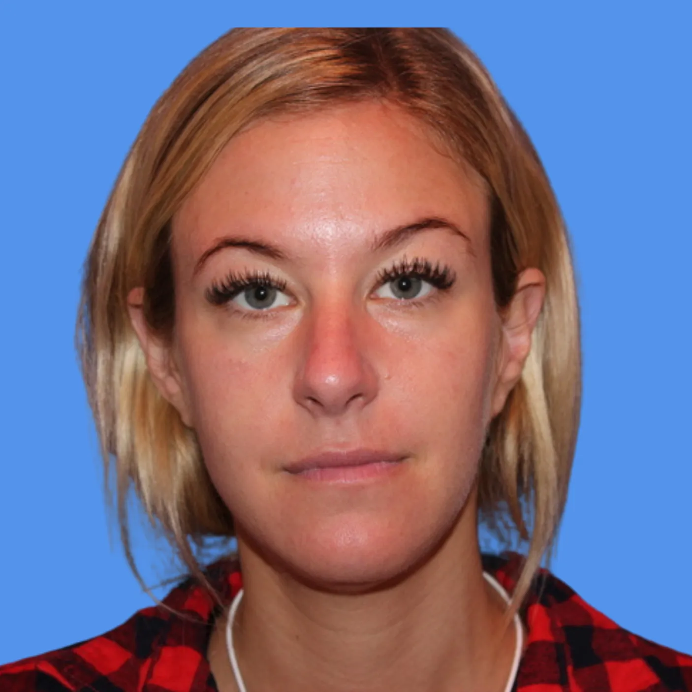 After - Facial Balancing / Fillers Patient 31