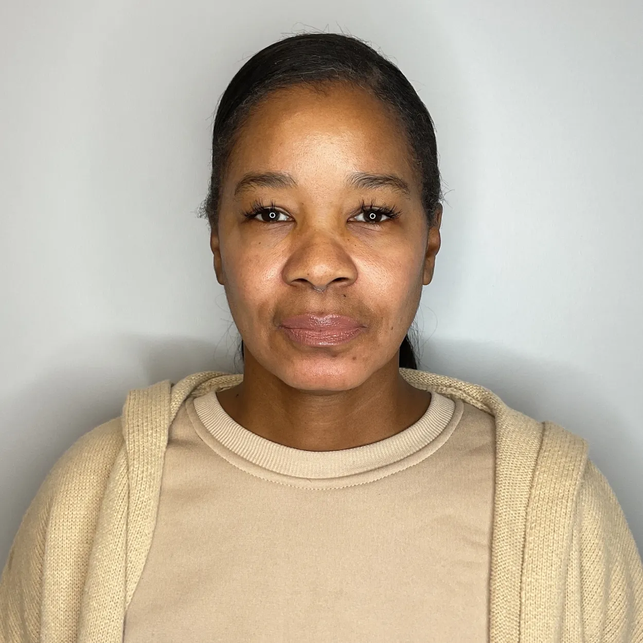 After - Facial Balancing / Fillers Patient 63