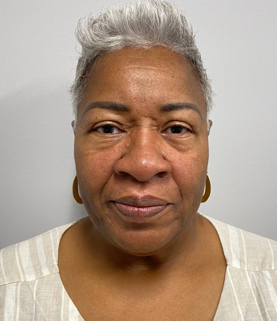 Before - Facial Balancing / Fillers Patient 71
