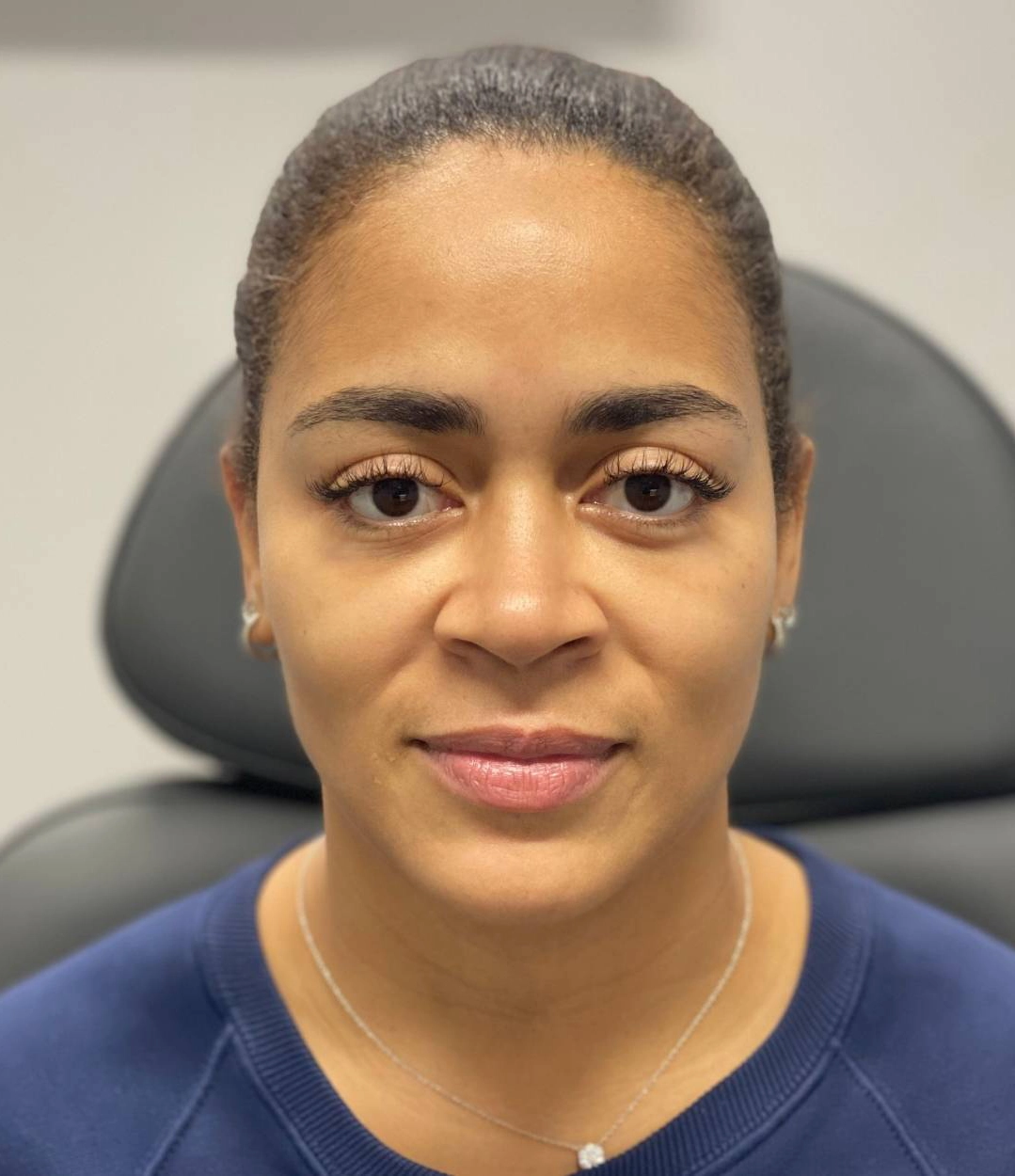After - Facial Balancing / Fillers Patient 73