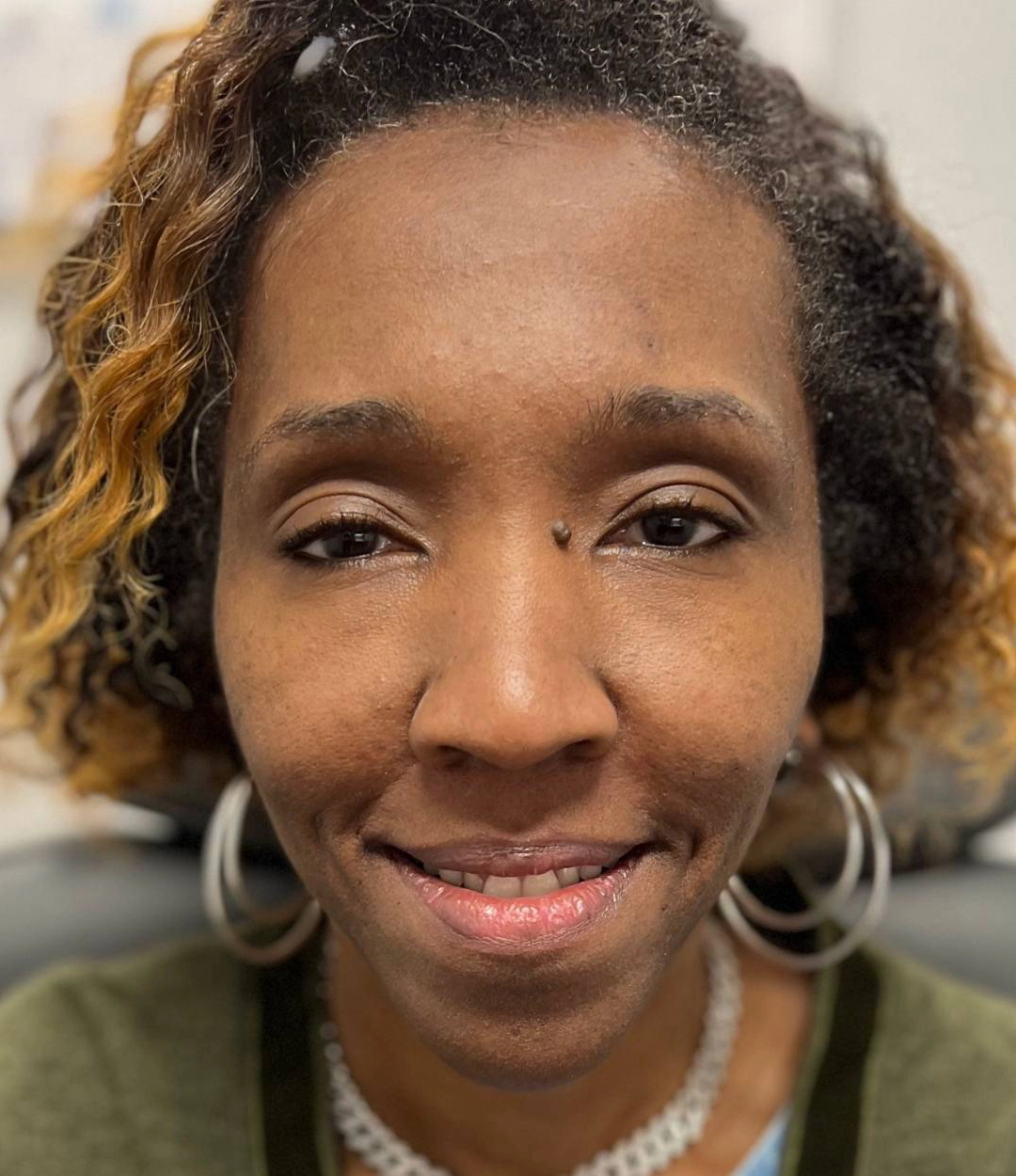 After - Facial Balancing / Fillers Patient 77