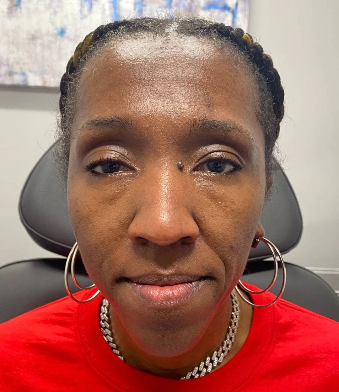 Before - Facial Balancing / Fillers Patient 77