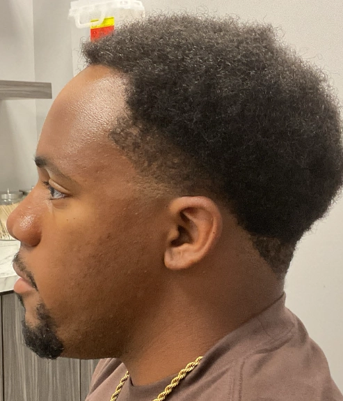 After - Hair Restoration Patient 130