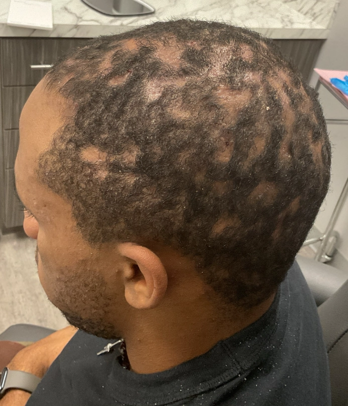 Before - Hair Restoration Patient 130