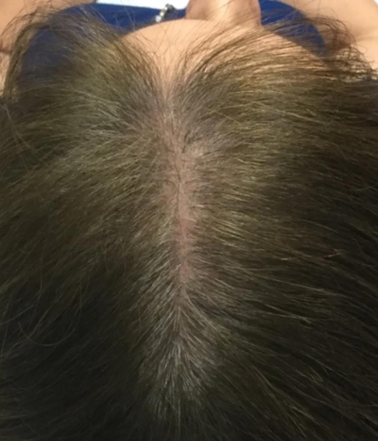 After - Hair Restoration Patient 19