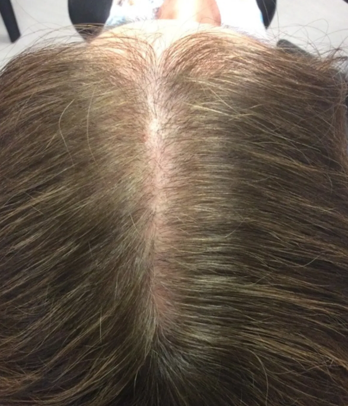 Before - Hair Restoration Patient 19
