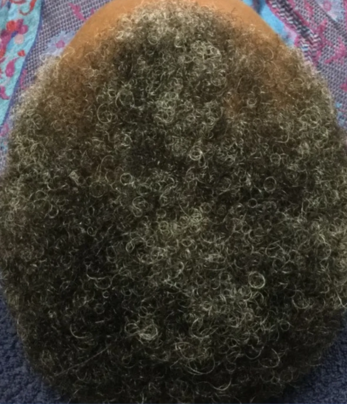 After - Hair Restoration Patient 23