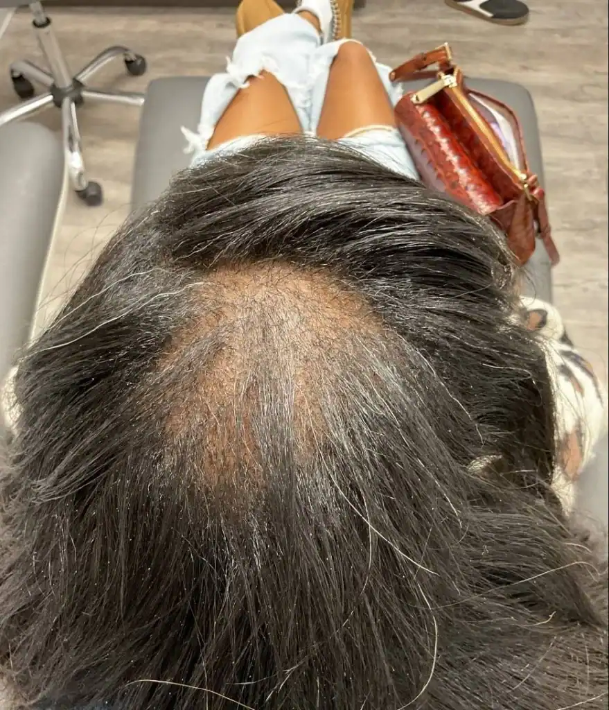 After - Hair Restoration Patient 49