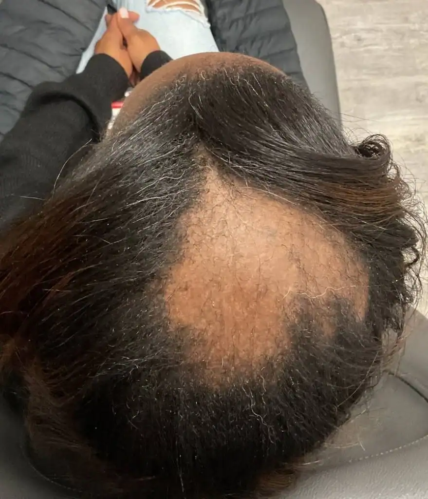 Before - Hair Restoration Patient 49