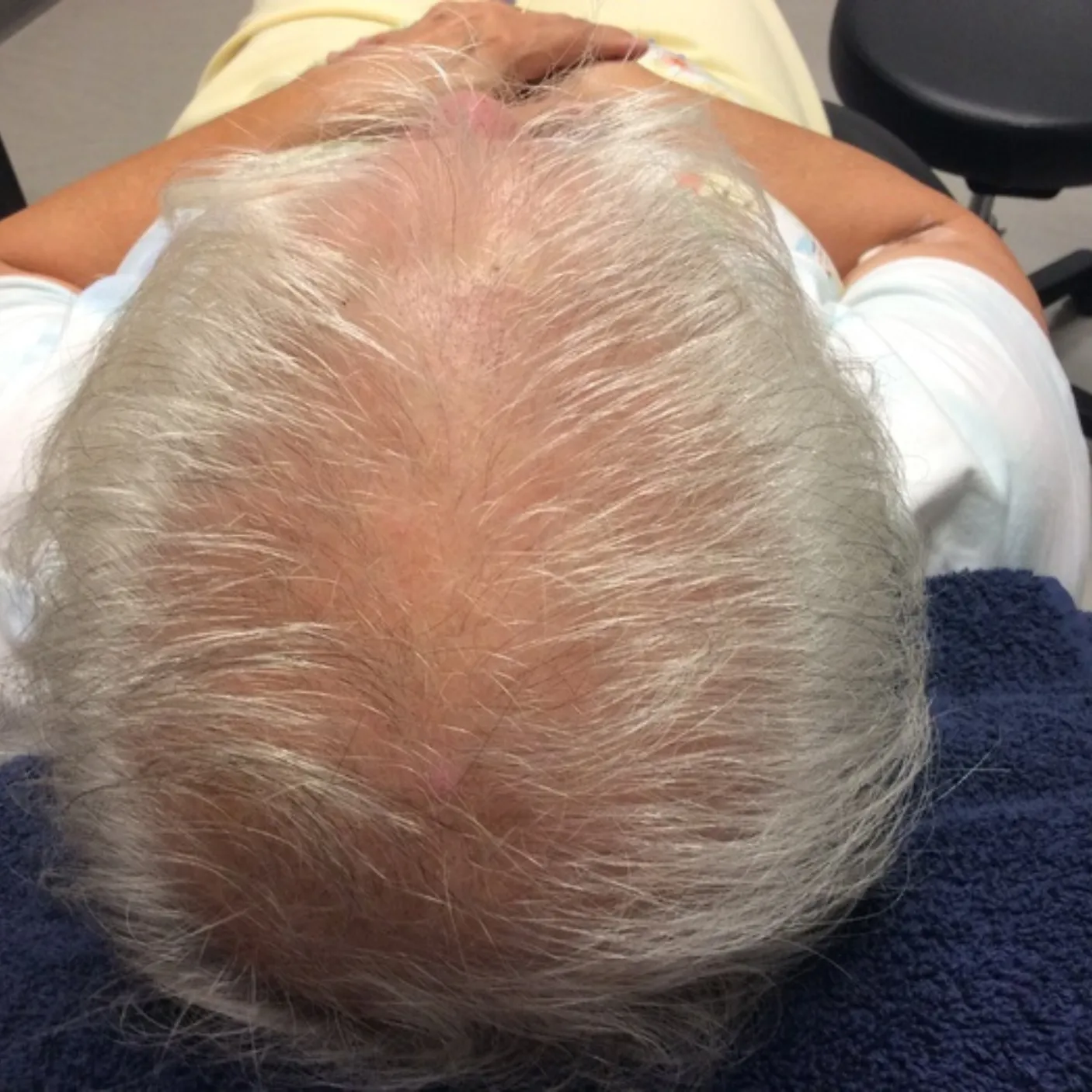 Before - Hair Restoration Patient 17