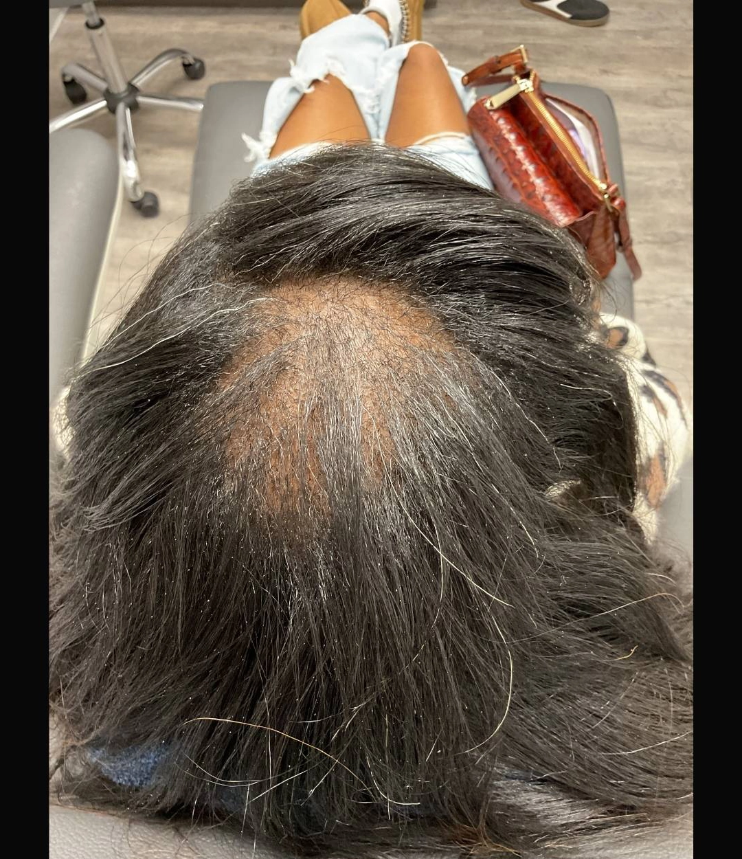 After - Hair Restoration Patient 49