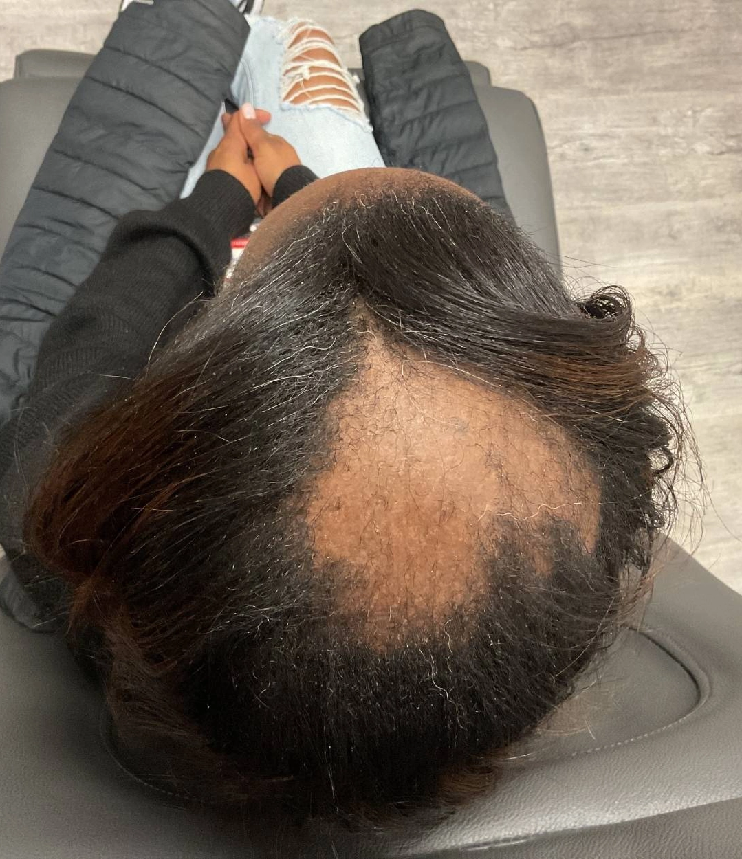 Before - Hair Restoration Patient 49