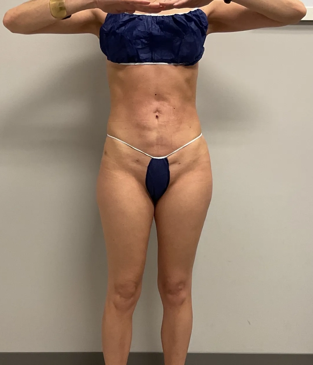 After - Liposuction / Body Sculpting Patient 59