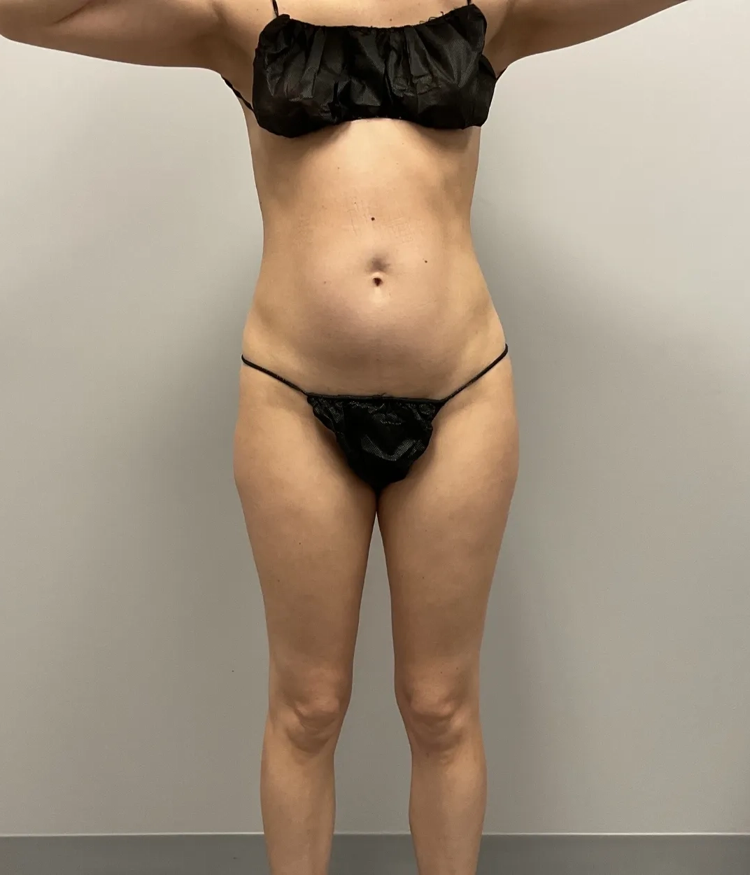 Before - Liposuction / Body Sculpting Patient 59