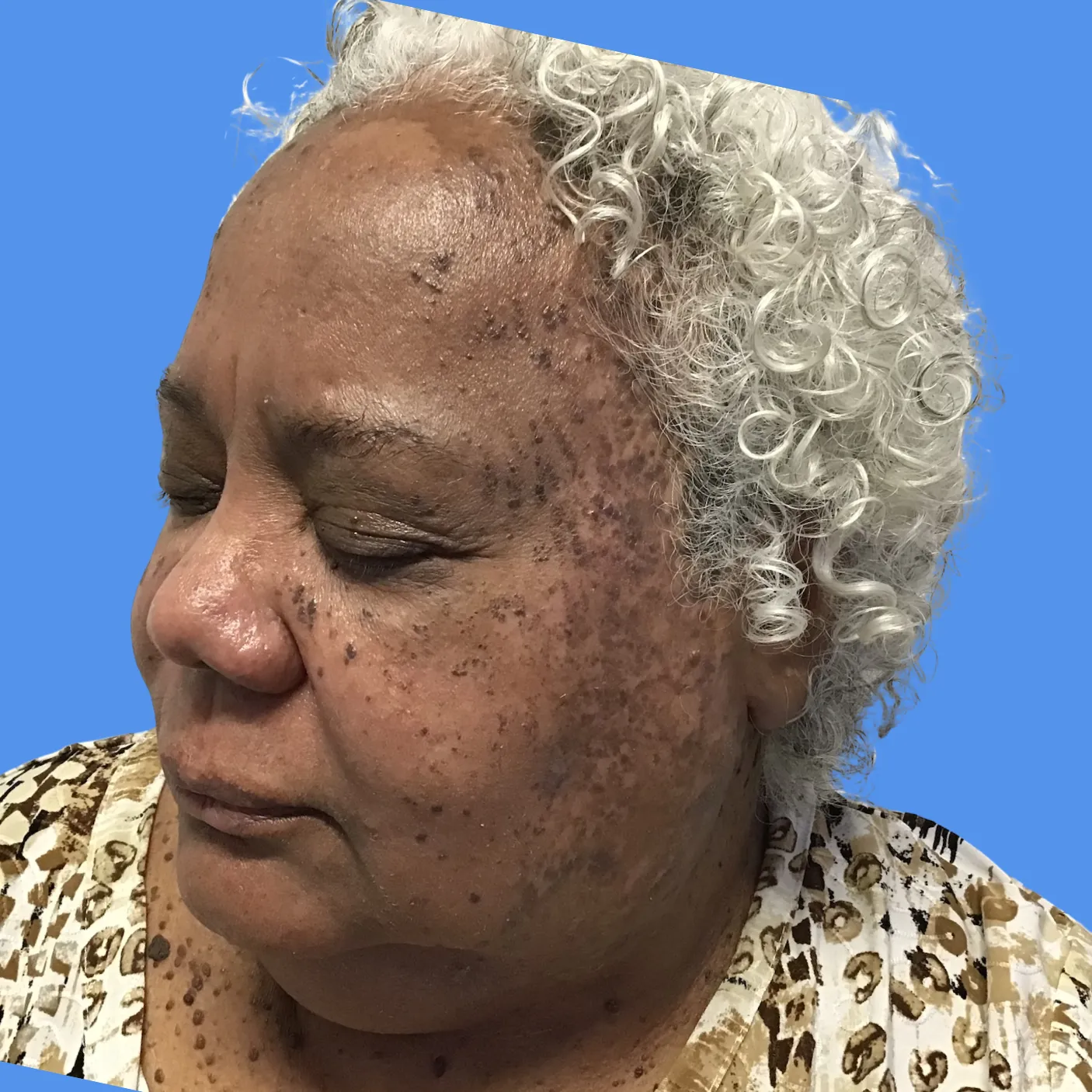 After - Mole Removal Patient 43