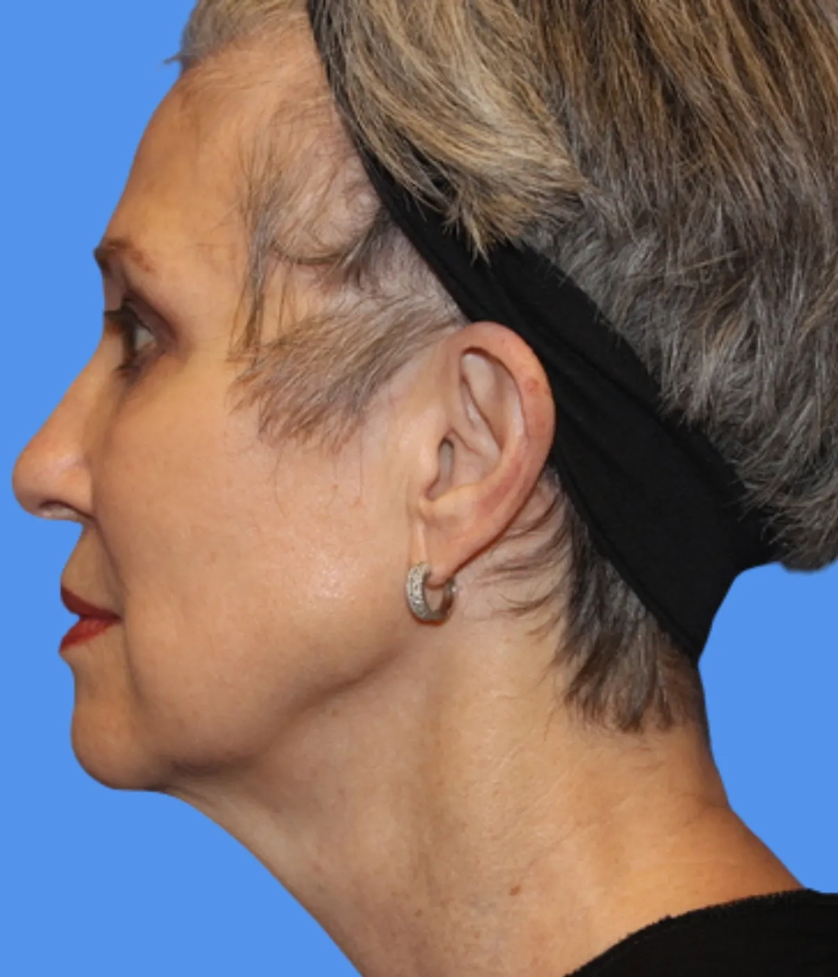 After - Skin Tightening Patient 1