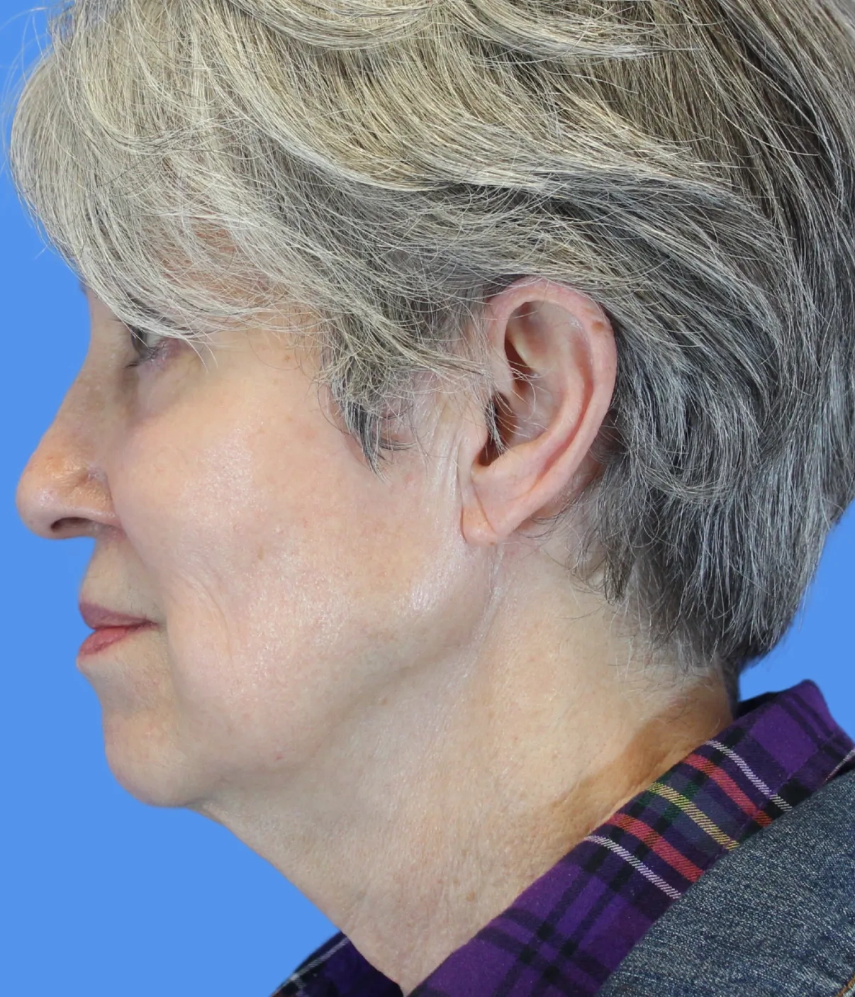 Before - Skin Tightening Patient 1