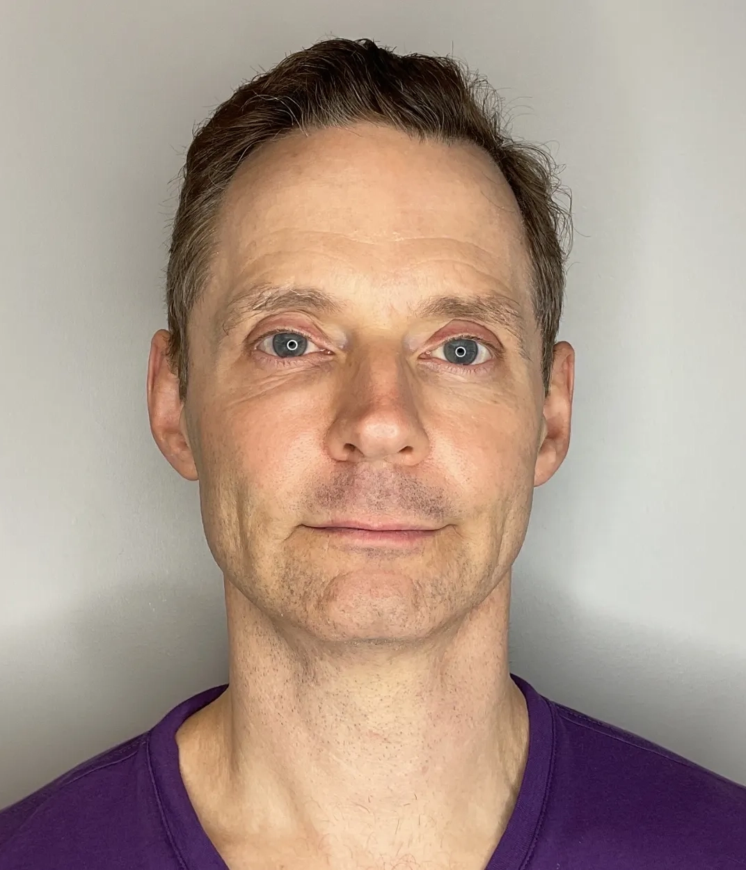 After - Skin Tightening Patient 55