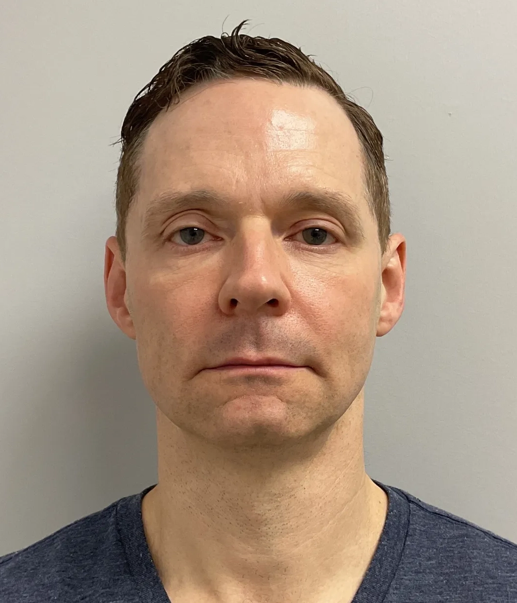 Before - Skin Tightening Patient 55