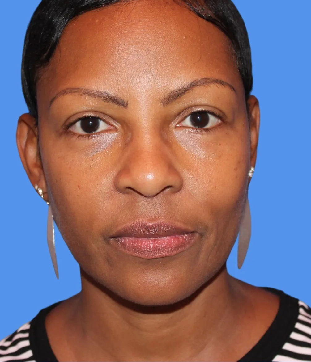 After - Skin Tightening Patient 9