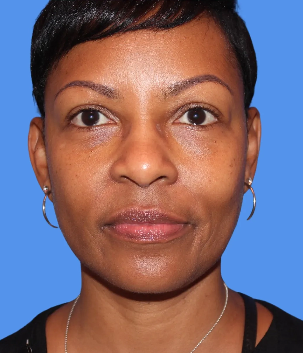 Before - Skin Tightening Patient 9