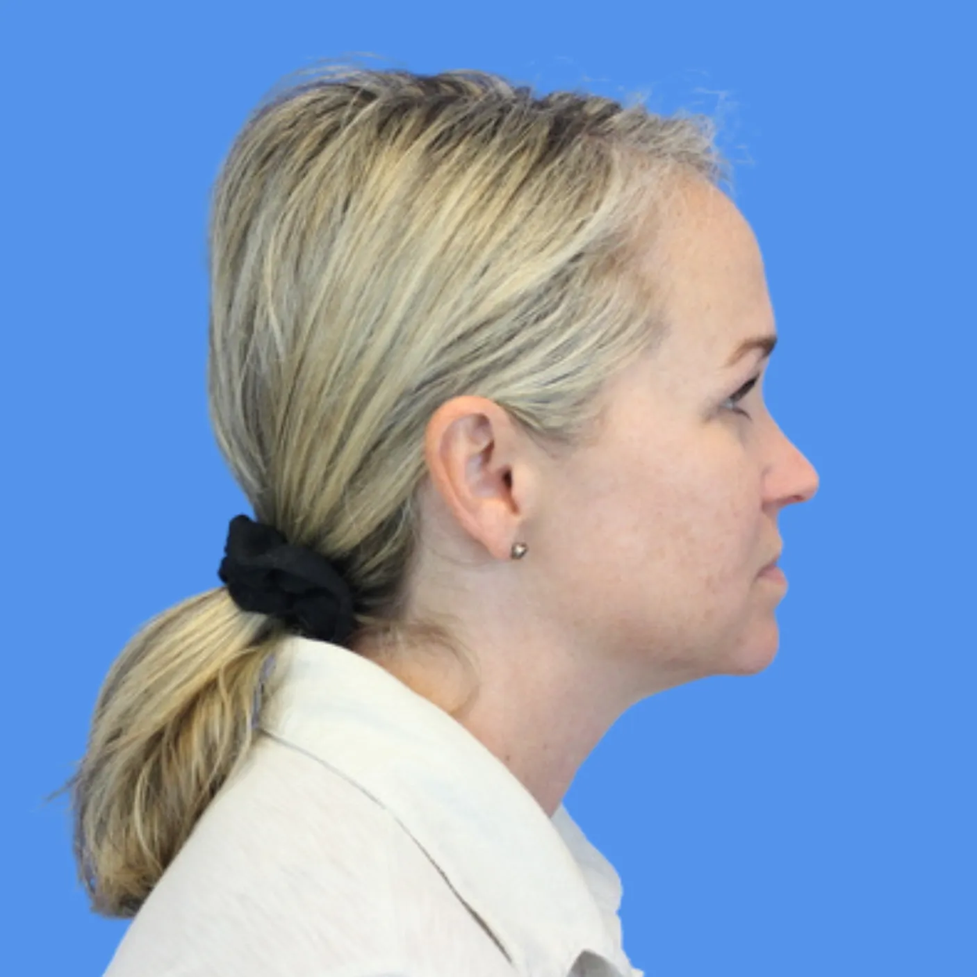 After - Skin Tightening Patient 25
