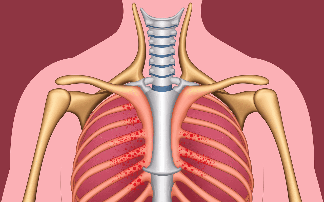 Coupe anatomique tendinite poignet montrant inflammation