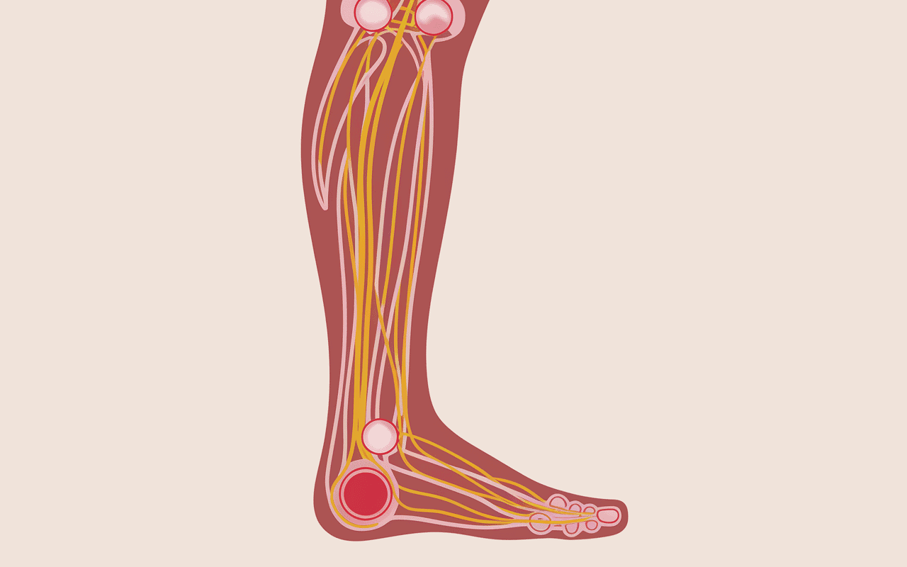 Schéma nerf sural douleur et inflammation