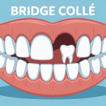 prix bridge collé visuel bouche stylisée