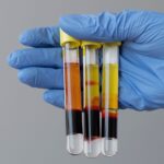 Trattamento prp per disfunzione erettlie