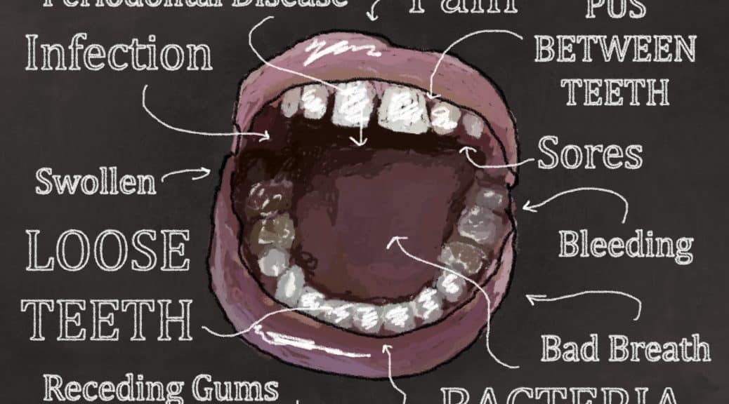 semaglutide bleeding gums Treatment in Philadelphia PA Bleeding Gums Might be a