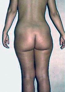 cellulite fiborsa