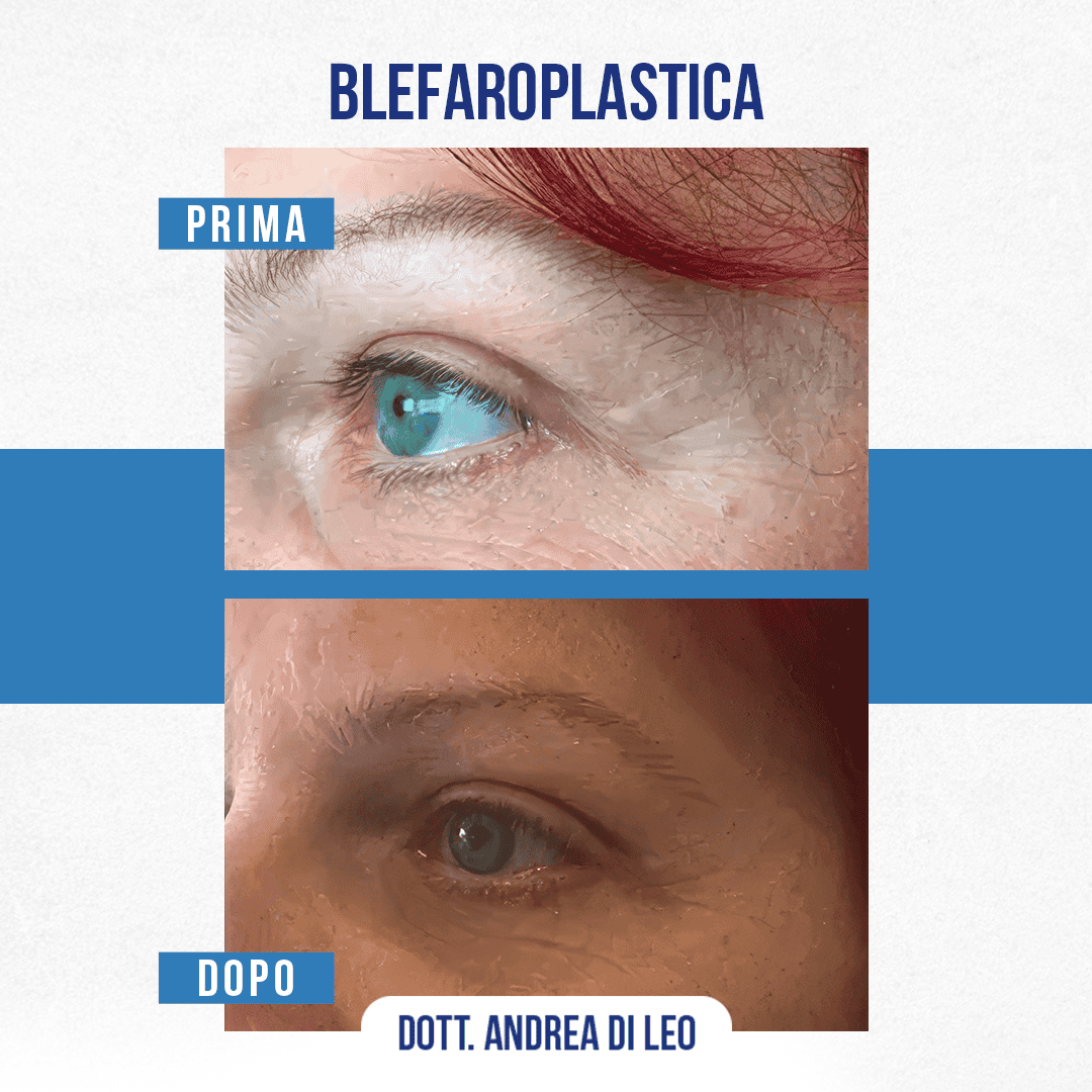 BLEFAROPLASTICA