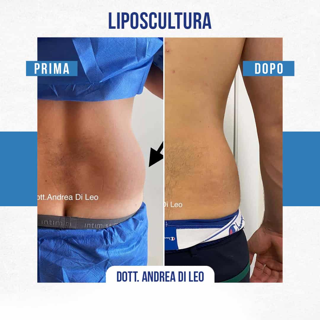IMG-LIPOSCULTURA-01