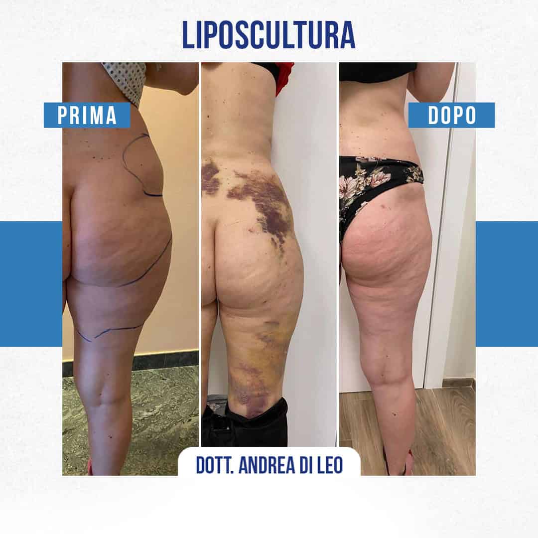 IMG-LIPOSCULTURA-03